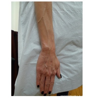 Before Image: Hand Vein Phlebectomy - front