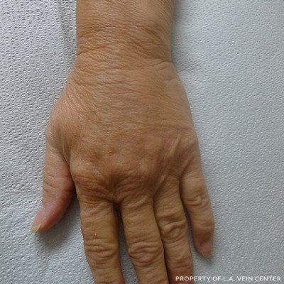 After Image: Hand Vein Treatment - front