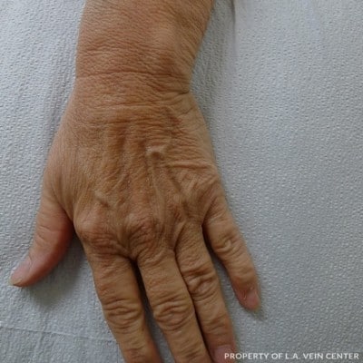 Before Image: Hand Vein Treatment - front