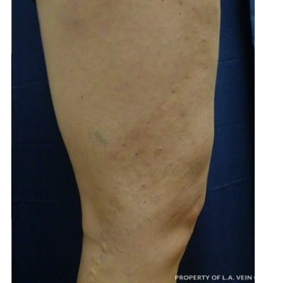 After Image: Varicose Vein Treatment - front