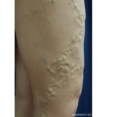 Before Image: Varicose Vein Treatment - front