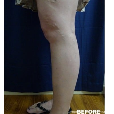 Before Image: Phlebectomy - other