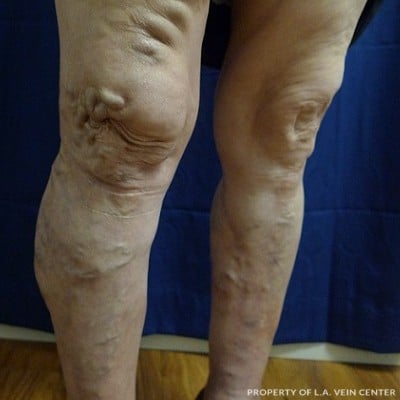 Before Image: Varicose Vein Treatment - front