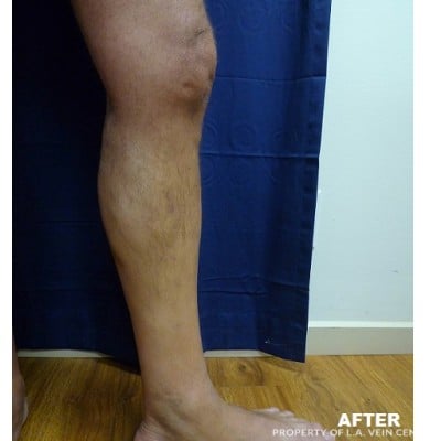 After Image: Varicose Vein - front