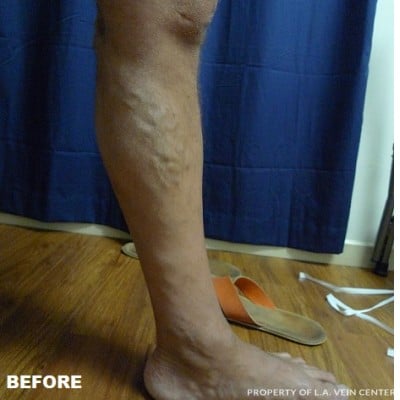 Before Image: Varicose Vein - front