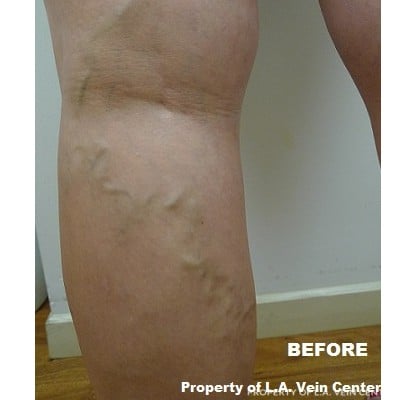 Before Image: Phlebectomy - back