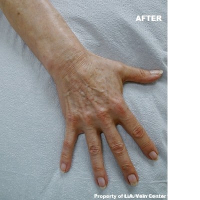 After Image: Hand Veins Sclerotherapy - front