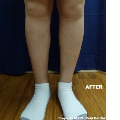 After Image: Phlebectomy - front