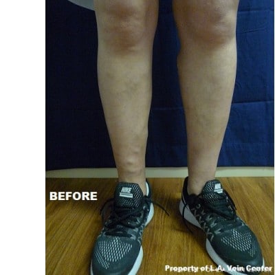 Before Image: Phlebectomy - front