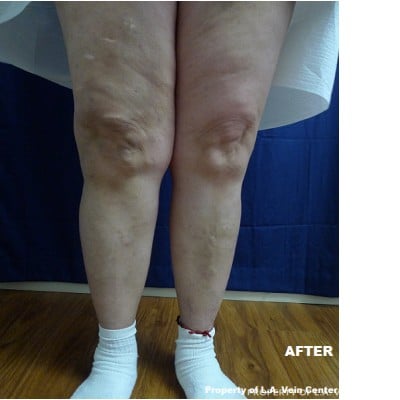 After Image: Varicose Vein Treatment - front