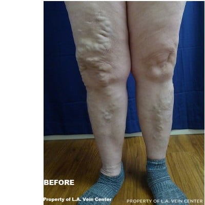 Before Image: Varicose Vein Treatment - front