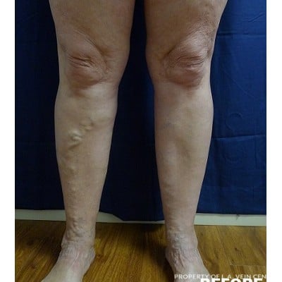 Before Image: Varicose Veins - front