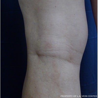 After Image: Varicose Veins - back