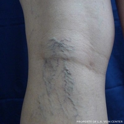 Before Image: Varicose Veins - back