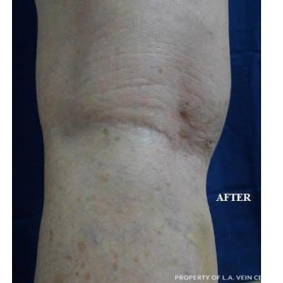 After Image: Spider Veins - front