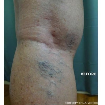 Before Image: Spider Veins - front
