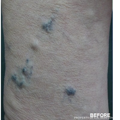 Before Image: Varicose Veins - front