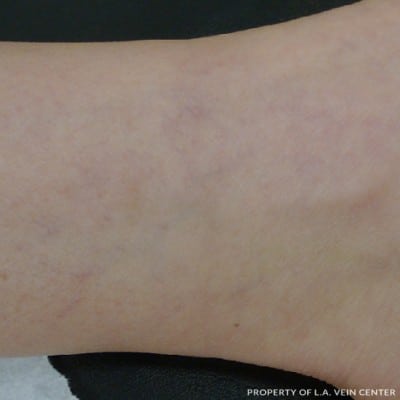 After Image: Spider Veins - front