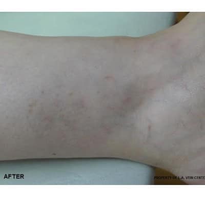After Image: Spider Veins - front