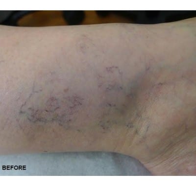Before Image: Spider Veins - front