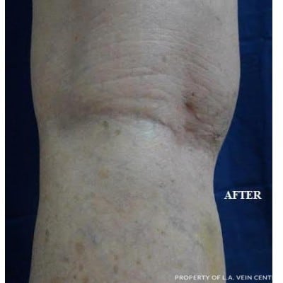 After Image: Varicose Veins - front