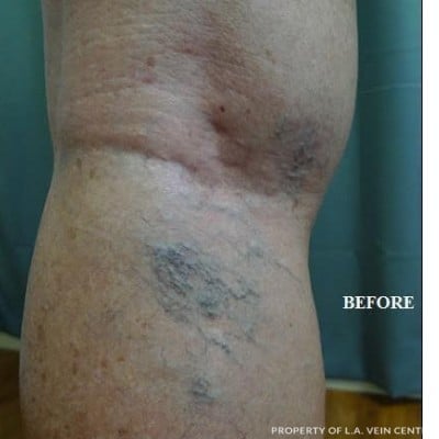 Before Image: Varicose Veins - front