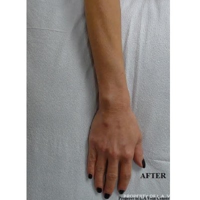 After Image: Hand Veins - front