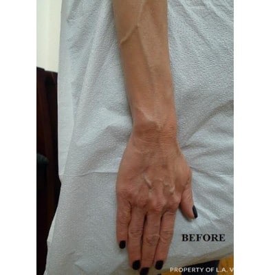 Before Image: Hand Veins - front
