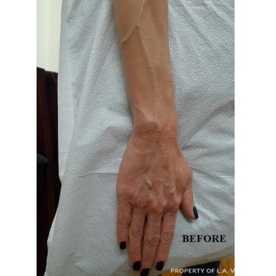 Hand Veins