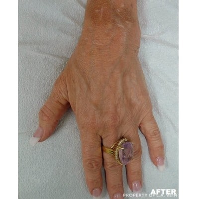 After Image: Hand Veins - front