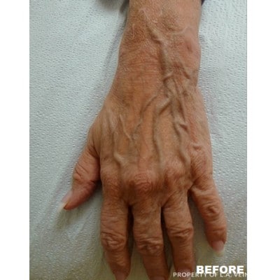 Before Image: Hand Veins - front