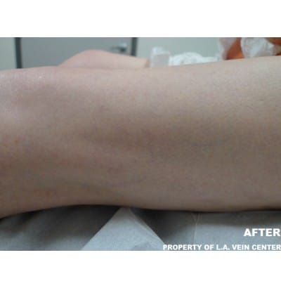 After Image: Spider Veins - front