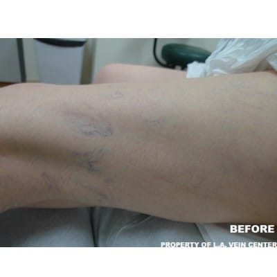 Before Image: Spider Veins - front