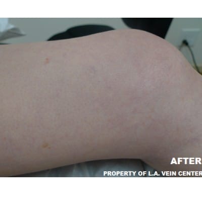 After Image: Spider Veins - front