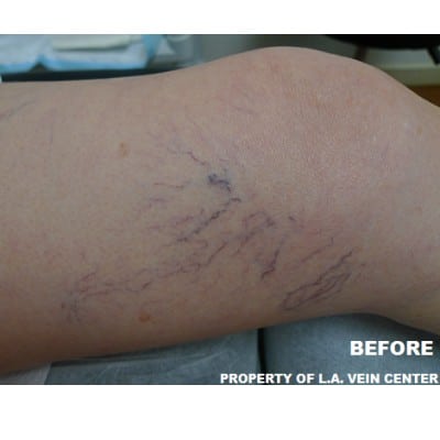 Before Image: Spider Veins - front
