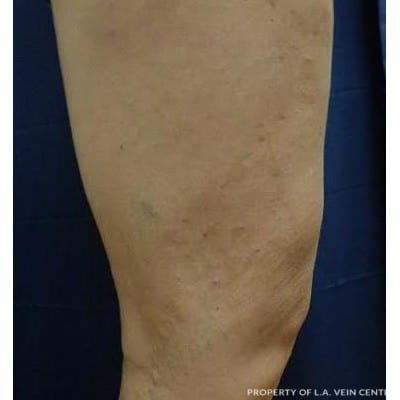 After Image: Varicose Veins - front