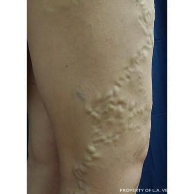 Before Image: Varicose Veins - front