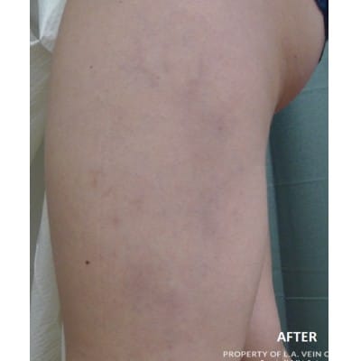 After Image: Spider Veins - front