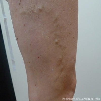 Before Image: Varicose Veins - other