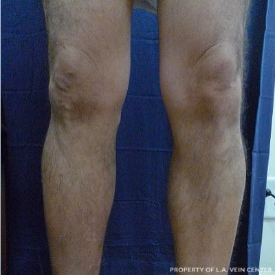 After Image: Varicose Veins - front