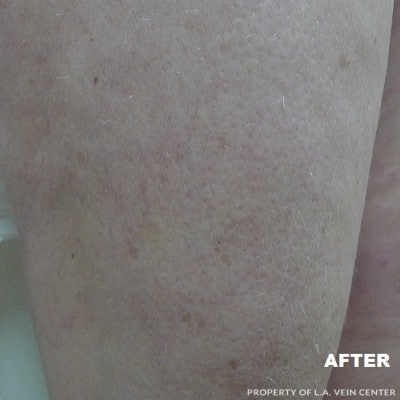 After Image: Spider Veins - front