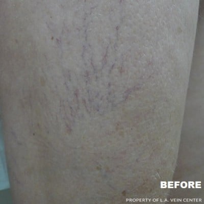 Before Image: Spider Veins - front