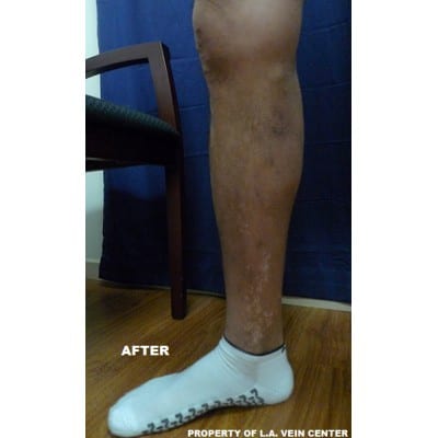 After Image: Varicose Veins - front