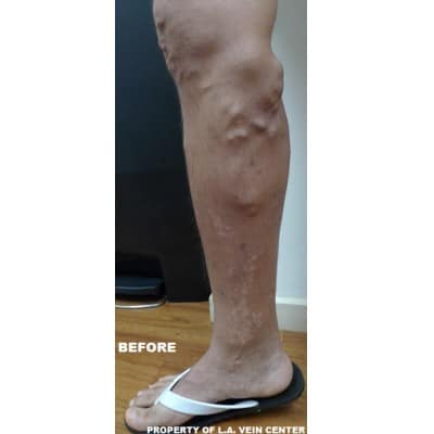 Before Image: Varicose Veins - front