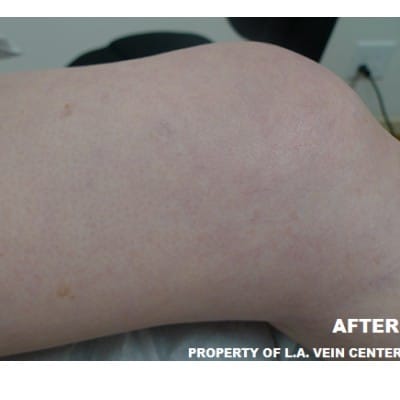 After Image: Spider Vein Treatment - front