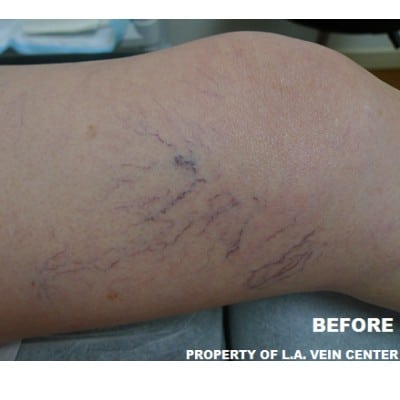 Before Image: Spider Vein Treatment - front