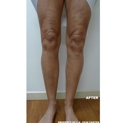 After Image: Varicose Veins - front
