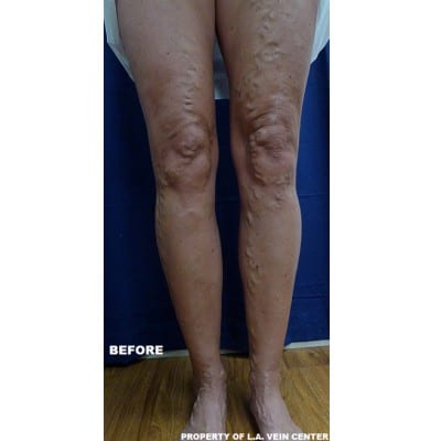 Before Image: Varicose Veins - front