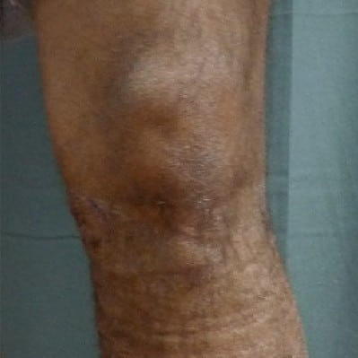 After Image: Phlebectomy - front