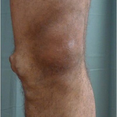 Before Image: Phlebectomy - front